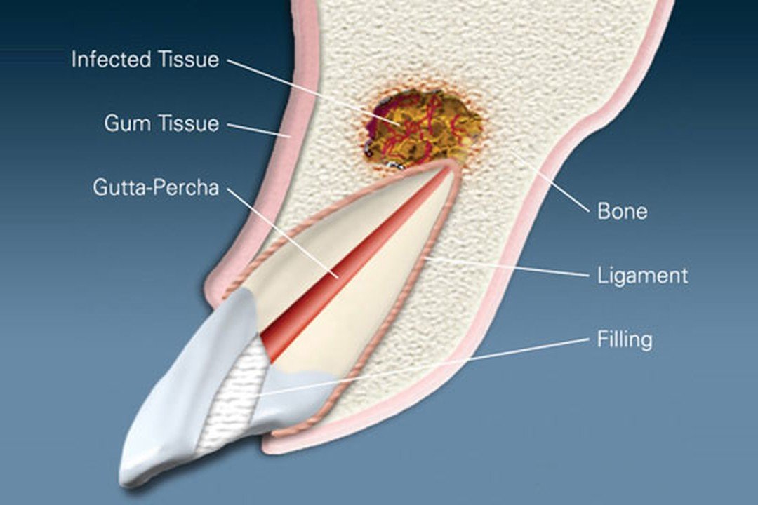 Apicoectomy (root-end surgery) diagram – Corpus Christi, TX